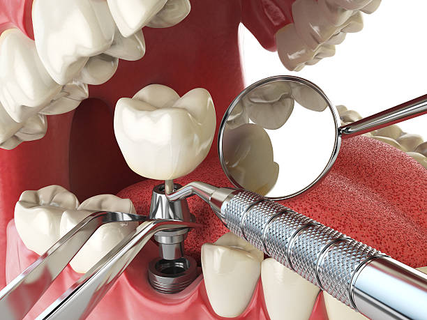 Best Dental Abscess Treatment in Edgefield, SC